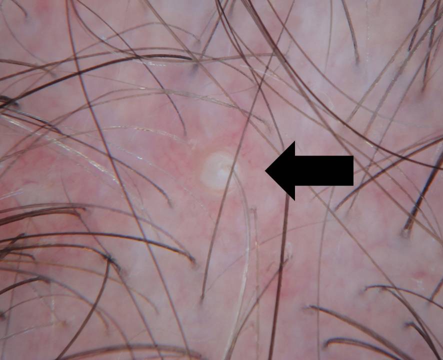 Hair Loss Terms Explained: Scalp Pustules — Donovan Hair Clinic