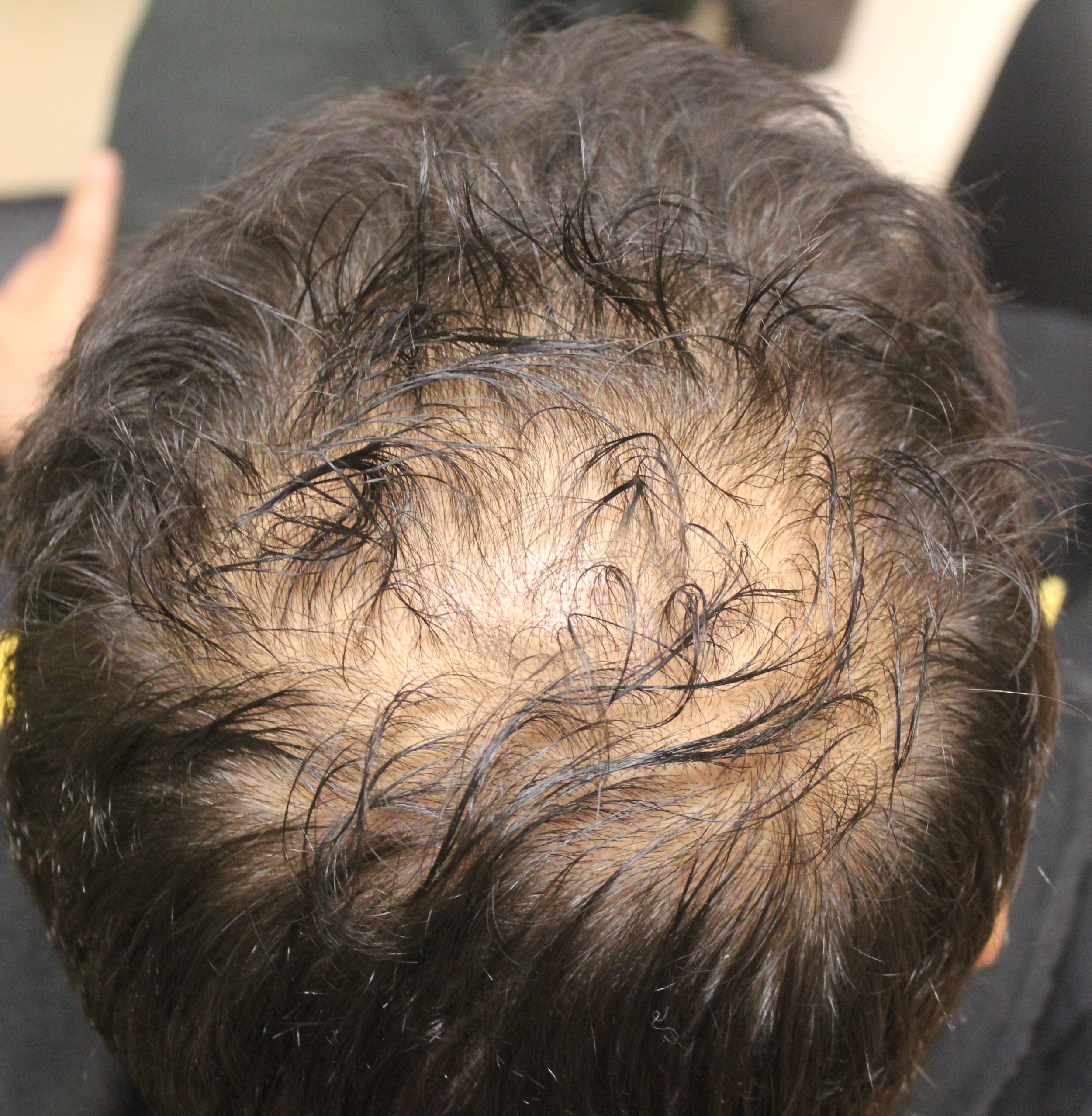 Finasteride Use by Young Men: Not only for Baldness in the Crown ! —  Donovan Hair Clinic