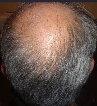 How many hair transplants can a patient have? — Donovan Hair Clinic