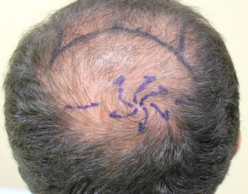 The Hair Whorl: Importance in Transplanting the Crown — Donovan Hair Clinic