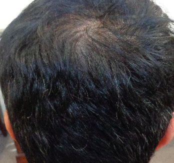 Dr. Donovan's Hair Loss Articles (2011-2023) — Donovan Hair Clinic