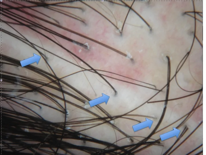trichophytic scar.jpg