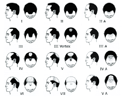Some men "destined" to develop with Hamilton Norwood class VI balding may only have 4000-5000 grafts available to move in their entire lifetime