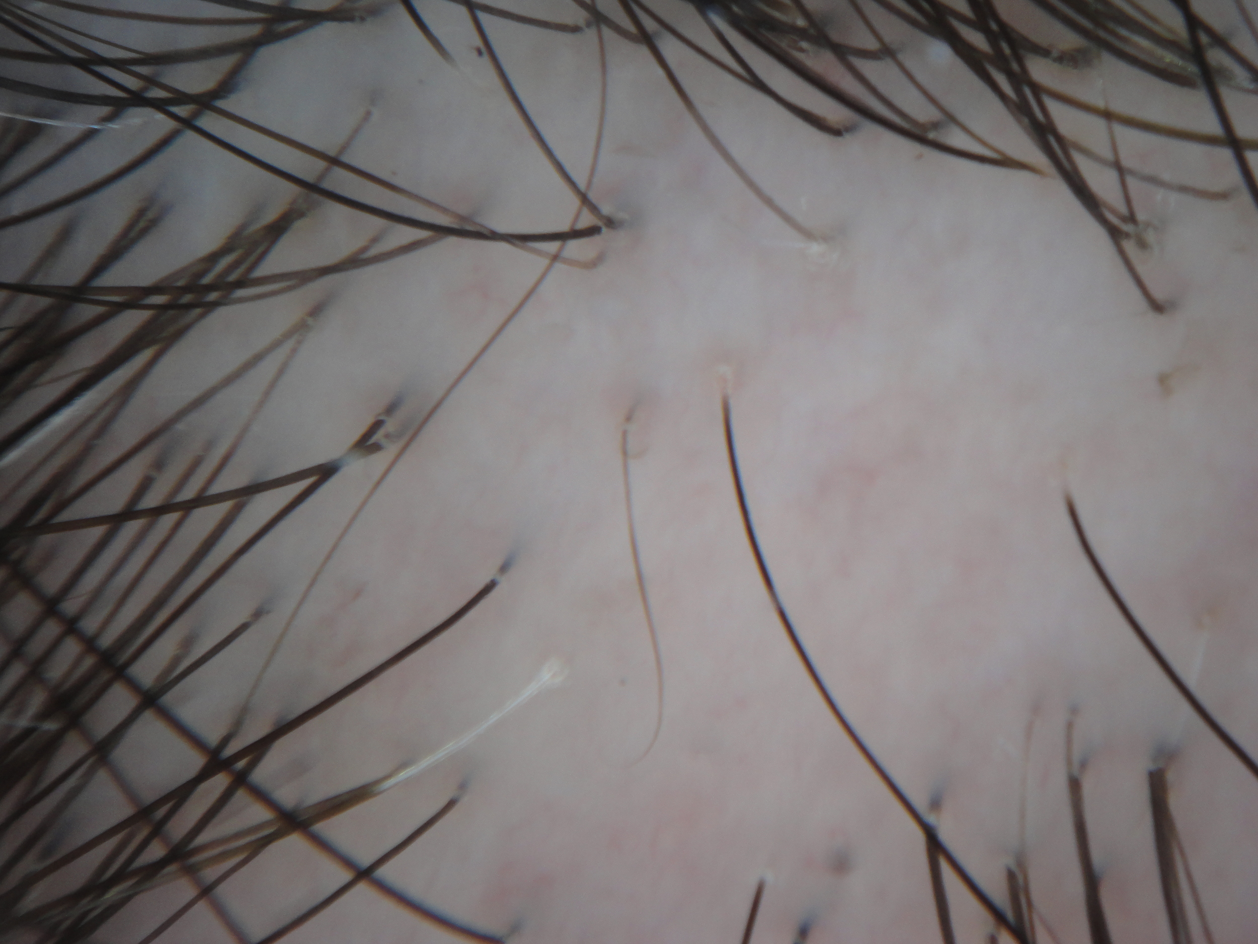 Hair regrowth in aggressively treated scarring alopecia. While total regrowth might not occur, regeneration a few hundred hairs will enable us to restore density with a hair transplant down the road - using far less grafts.