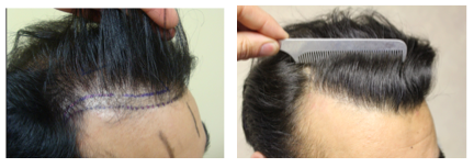 Achieving appropriate densities in hair transplantation — Donovan Hair  Clinic