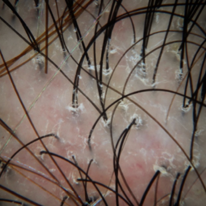 Scalp Dandruff: 