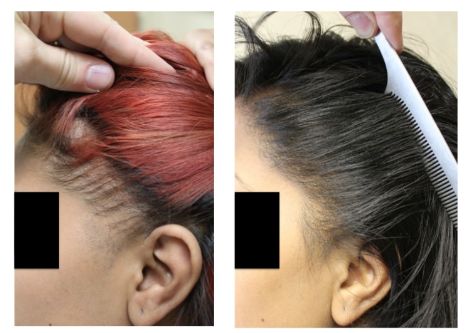 Restoration of the frontal hairline in a woman with traction alopecia. Photo: 12 months post op.