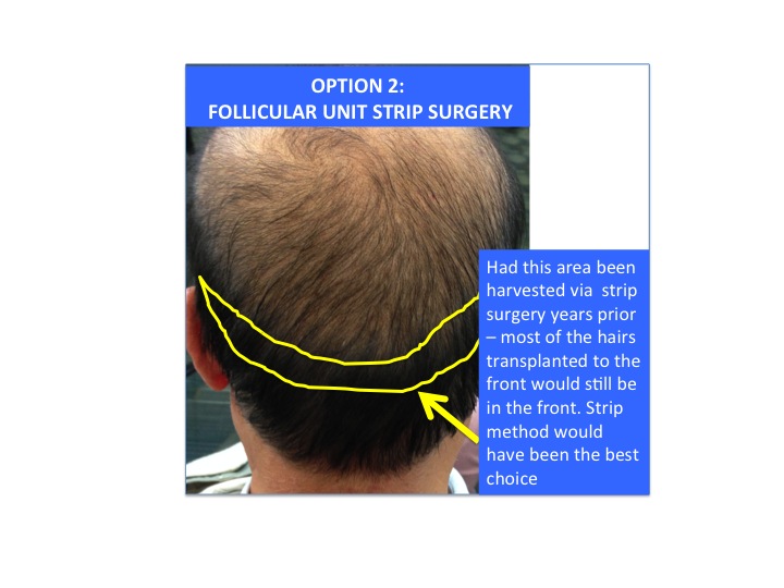 Should I get FUE or strip hair transplant surgery ? — Donovan Hair Clinic