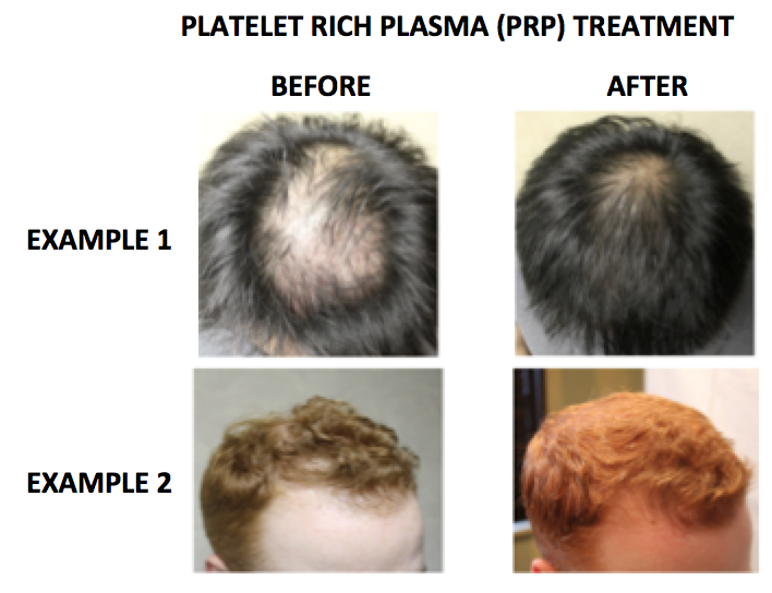 PLATELET RICH PLASMA (PRP) TREATMENTS — Donovan Hair Clinic