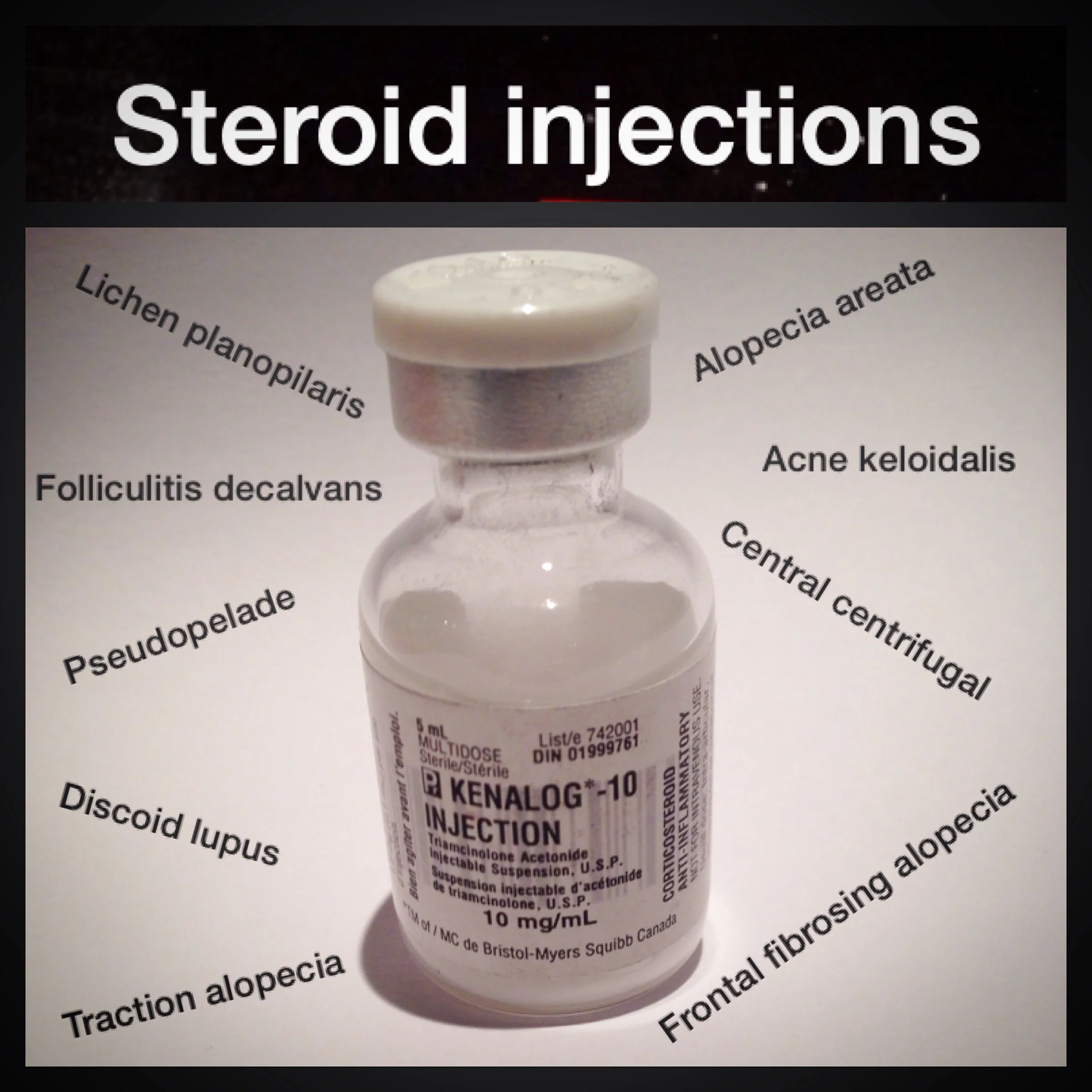 Steroid injections an essential part of the hair loss toolbox