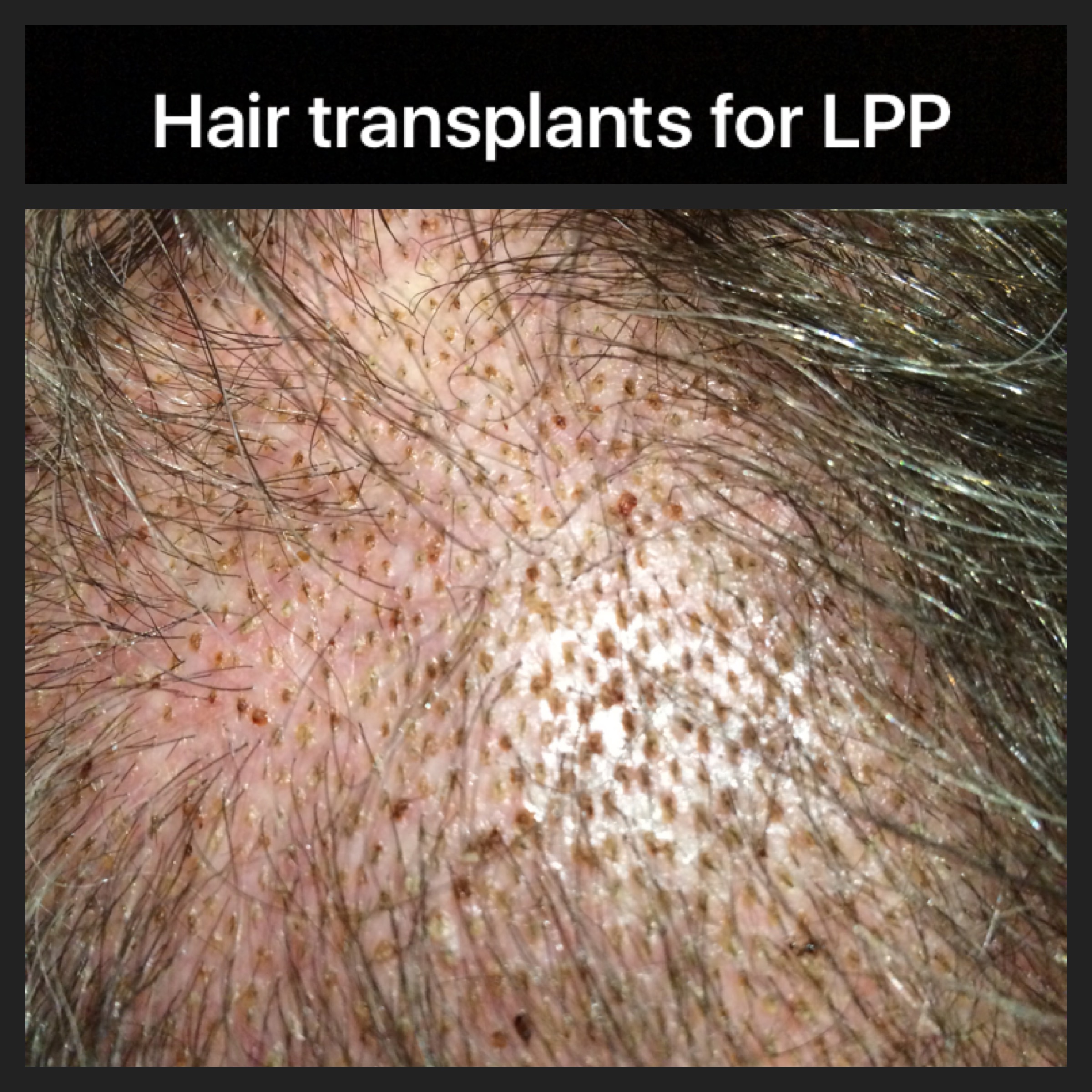 Hair transplants for Lichen planopilaris — Donovan Hair Clinic
