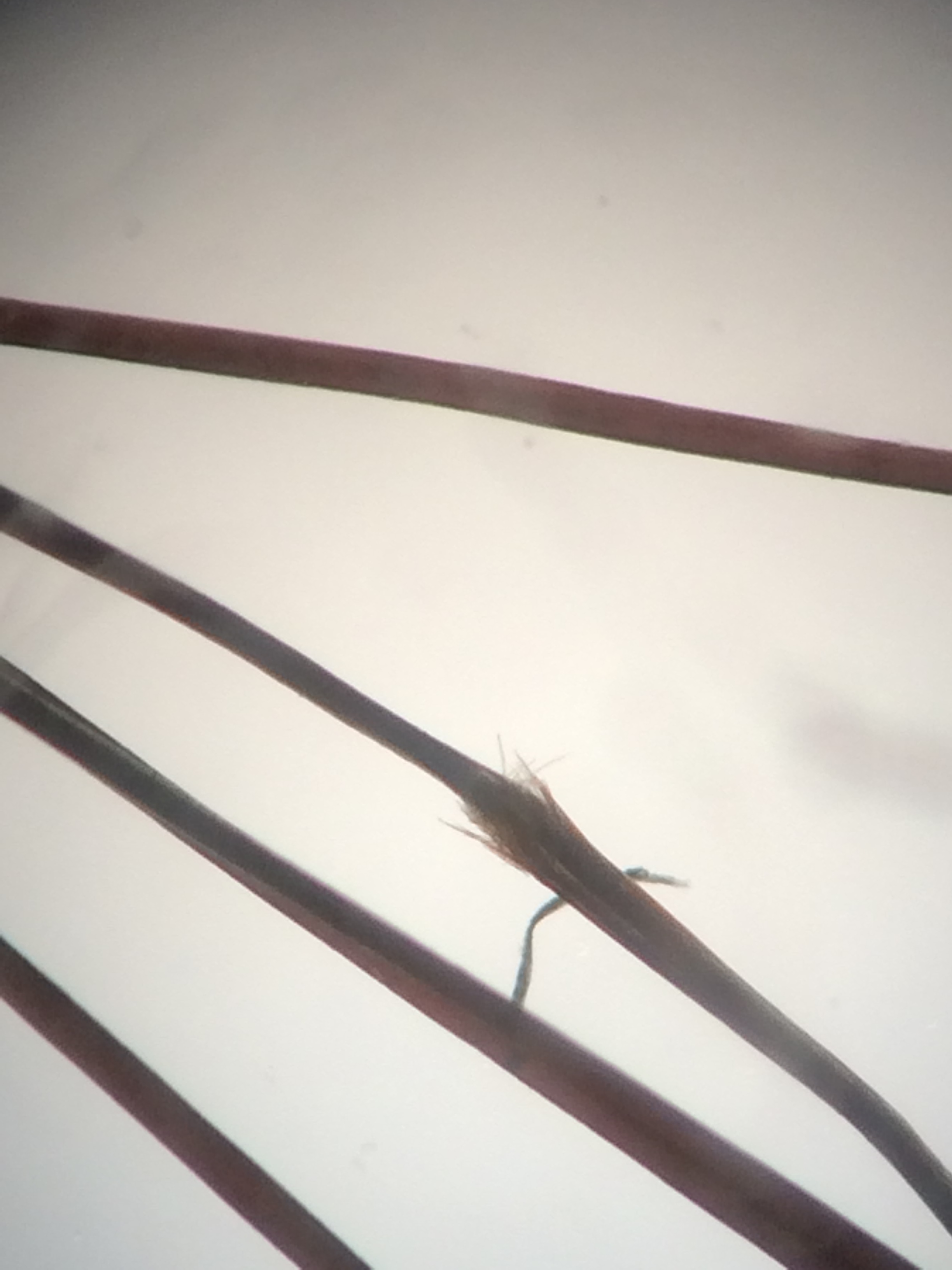 Hair breakage from methotrexate. Trichorrhexis nodosa is shown in one hair. 