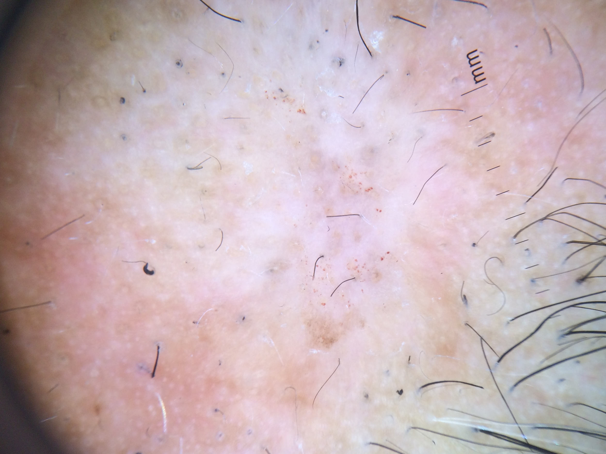 Trichotillomania - is the hair loss permanent? — Donovan Hair Clinic