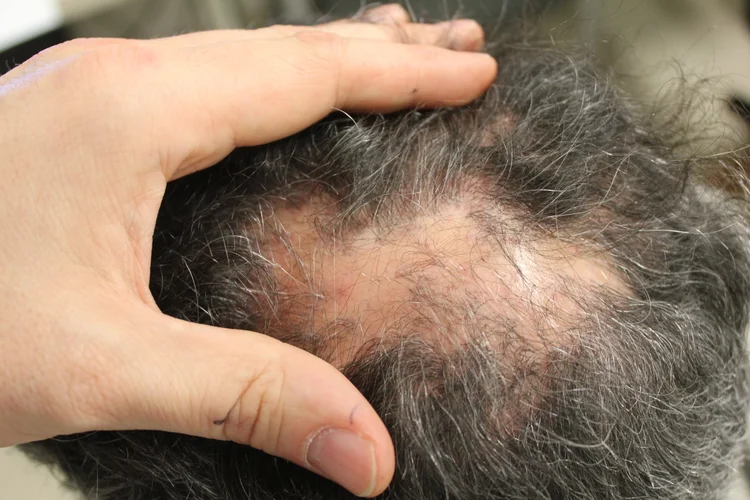 What are the most effective and best researched treatments for lichen