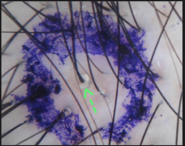 Scalp biopsies for hair loss Is it always needed? — Donovan Hair Clinic