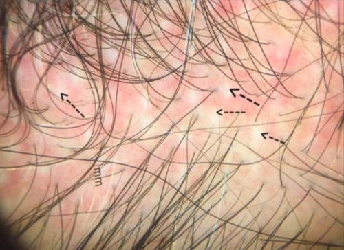 FUE: White Dots — Donovan Hair Clinic