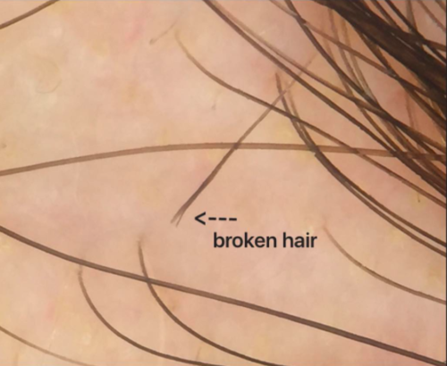 Exclamation Hairs=Broken Hairs — Donovan Hair Clinic