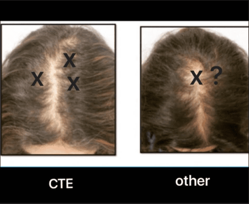 Where Should I Get My Scalp Biopsy Donovan Hair Clinic