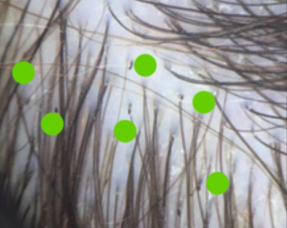Trichotillomania in Children.png
