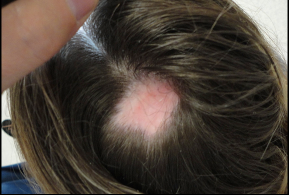 Scarring Alopecia from Hair dyes, highlights and bleach — Donovan Hair  Clinic