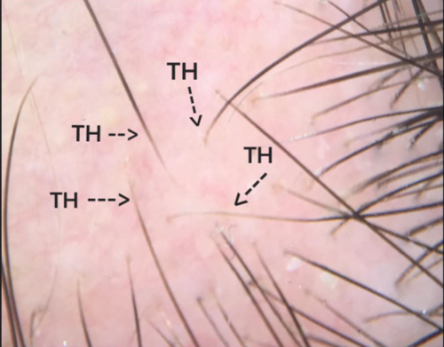 Tapered and Exclamation Mark Hairs in Alopecia Areata — Donovan Hair Clinic