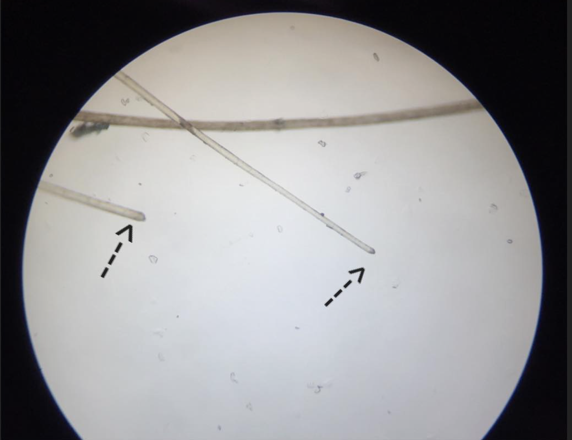 Dr Donovan S Hair Loss Articles 2011 2020 Donovan Hair Clinic