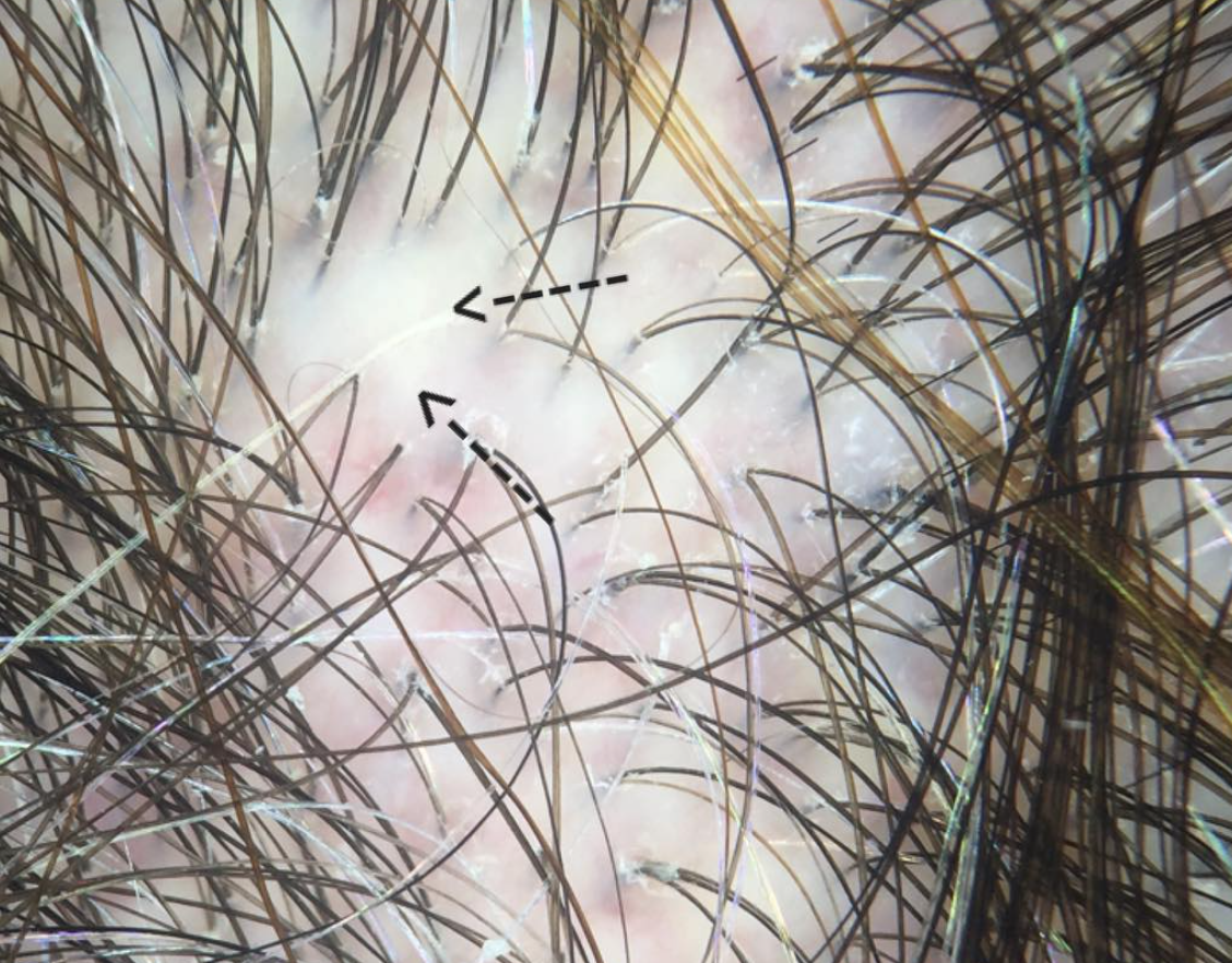 Scarring Alopecia Loss Of The Follicular Opening Is A Hallmark