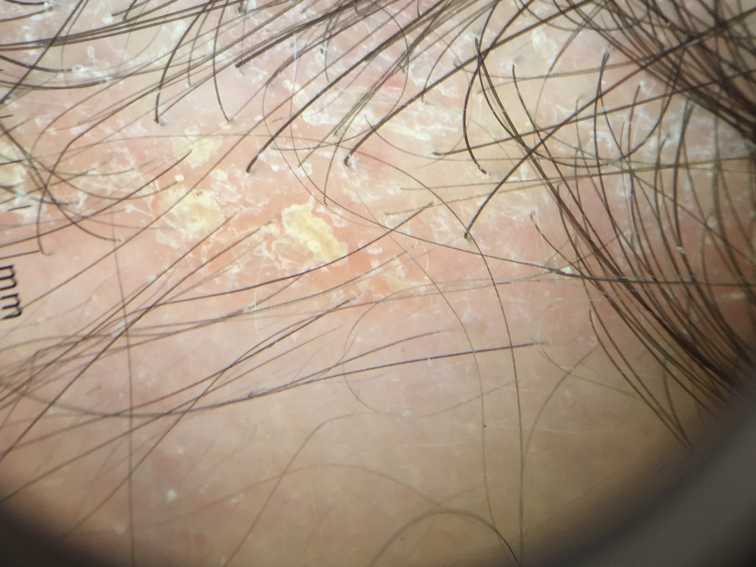 Seborrheic Dermatitis Scalp Scalp Hair Dandruff And Seborrheic