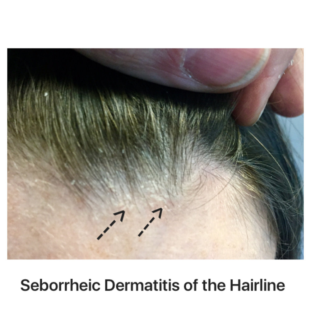 Can drugs cause or exacerbate seborrheic dermatitis? — Donovan Hair Clinic