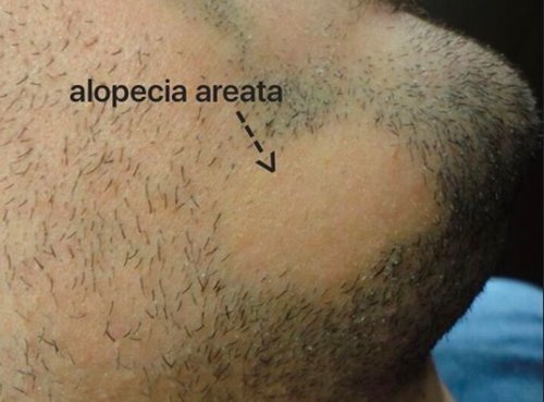 Scalp alopecia in men with beard alopecia: What are the risks? — Donovan  Hair Clinic