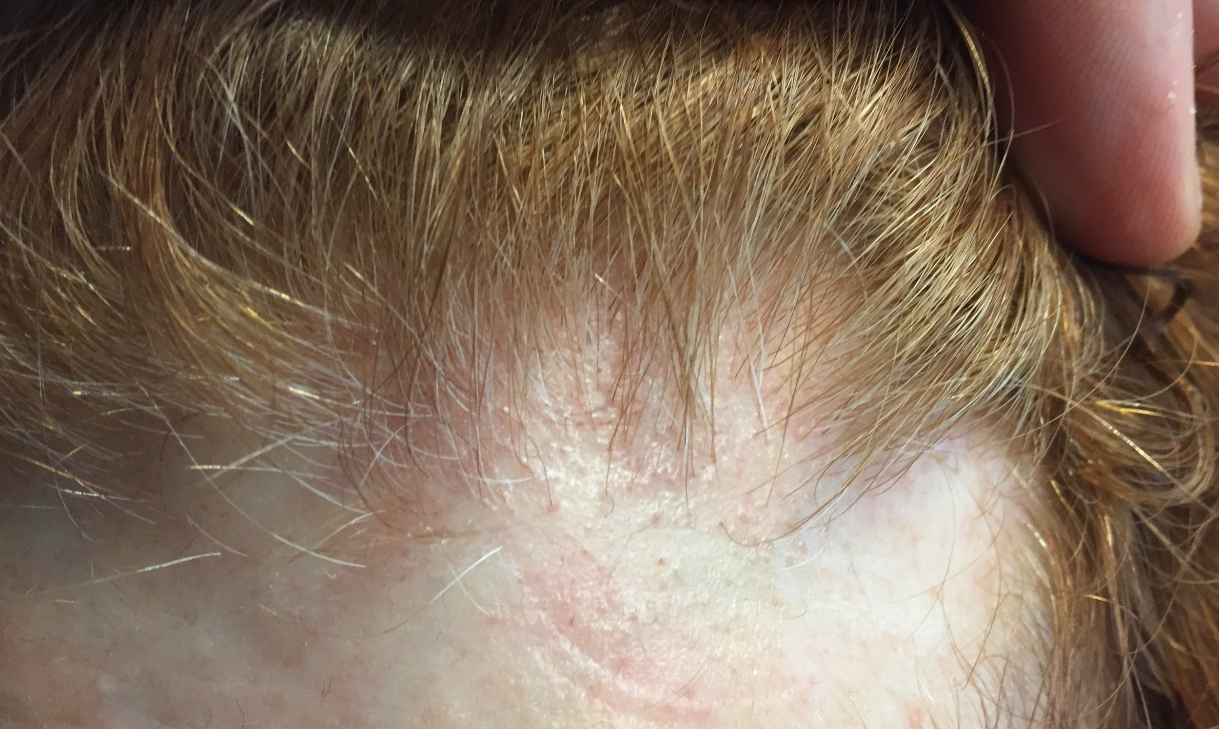 Do I have Frontal Fibrosing Alopecia? — Donovan Hair Clinic