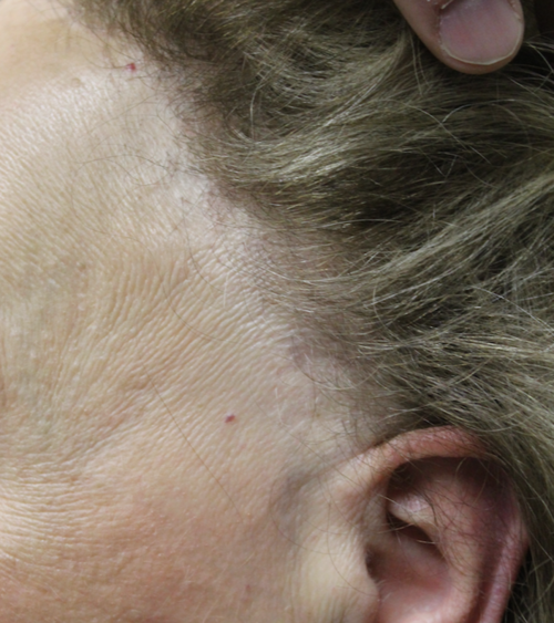 Treating Frontal fibrosing (FFA): Are retinoids than finasteride? — Hair