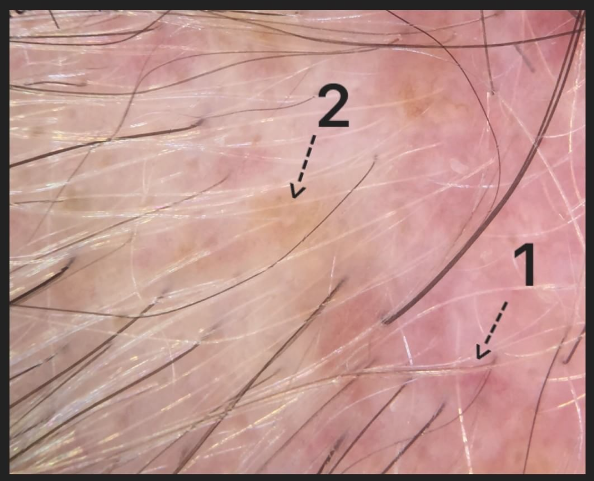 Signs of Sun Damage in Patients with Hair Loss — Donovan Hair Clinic