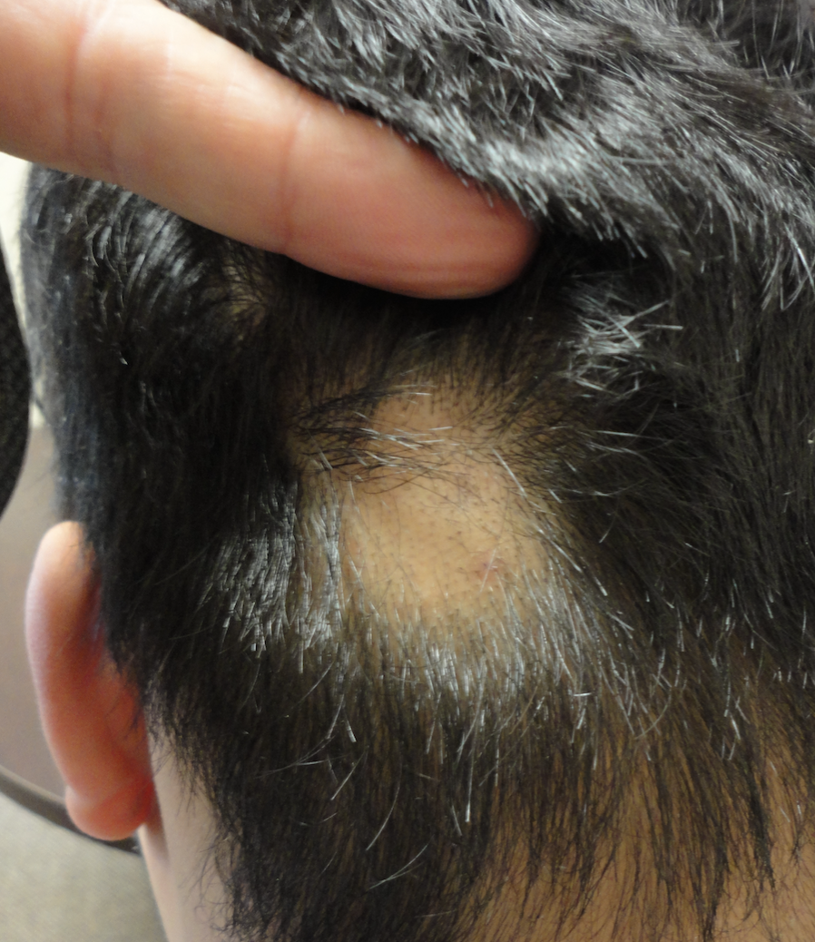 Minoxidil Use in Alopecia Useful or not? — Donovan Hair Clinic