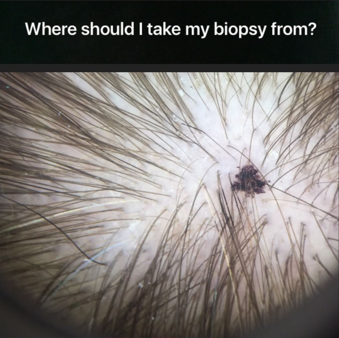 Where should a scalp biopsy be taken from? — Donovan Hair Clinic