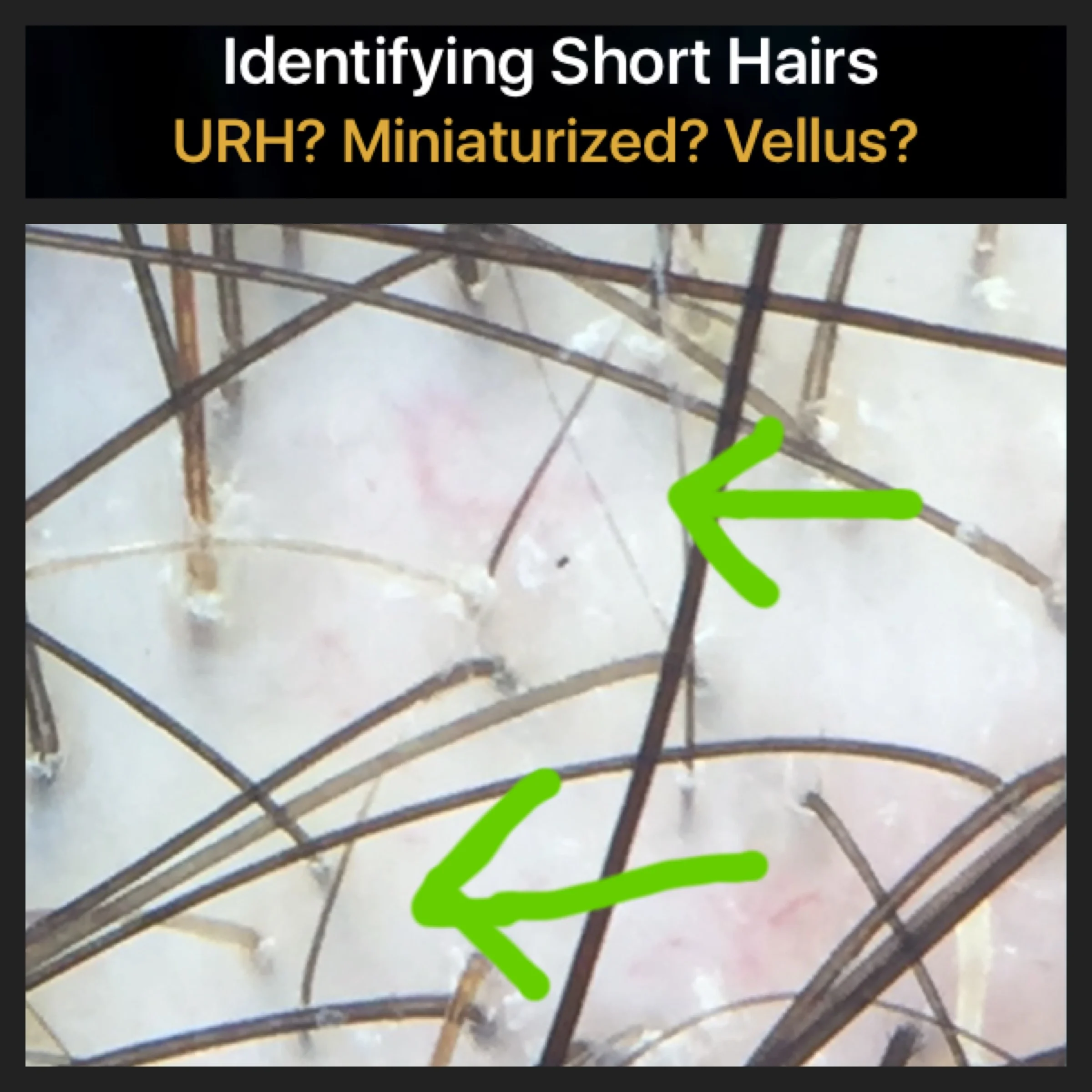 Differentiating Between Short 1 Cm Hairs By Dermoscopy Many