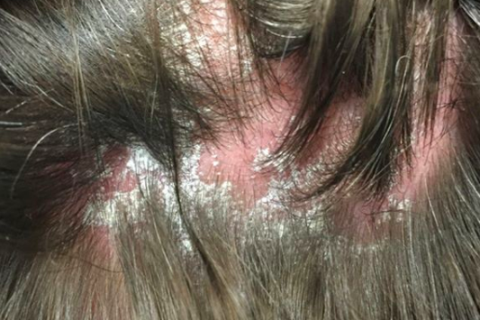 Can psoriasis also cause scarring? — Donovan Hair Clinic