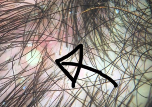 What causes scalp pustules? — Donovan Hair Clinic