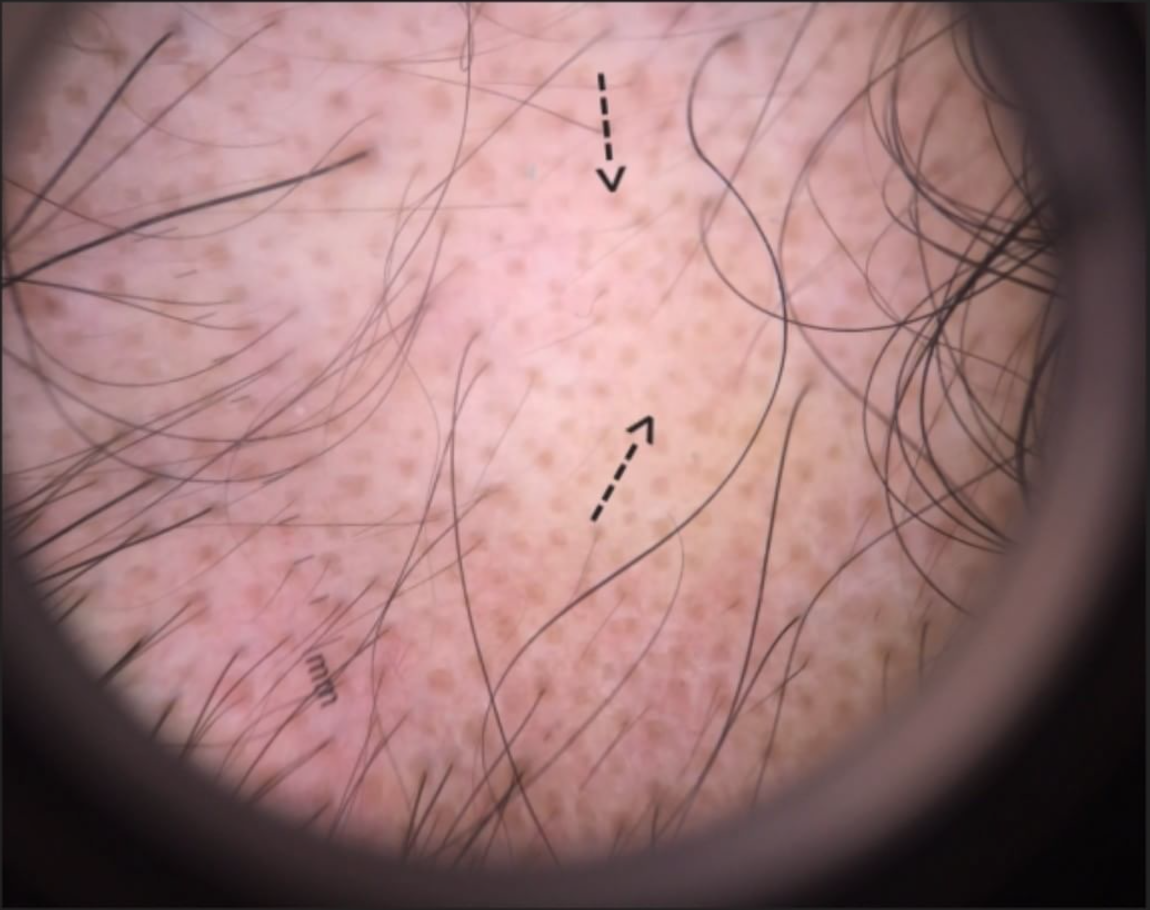 Alopecia areata: One of the many 'non-scarring' alopecias — Donovan