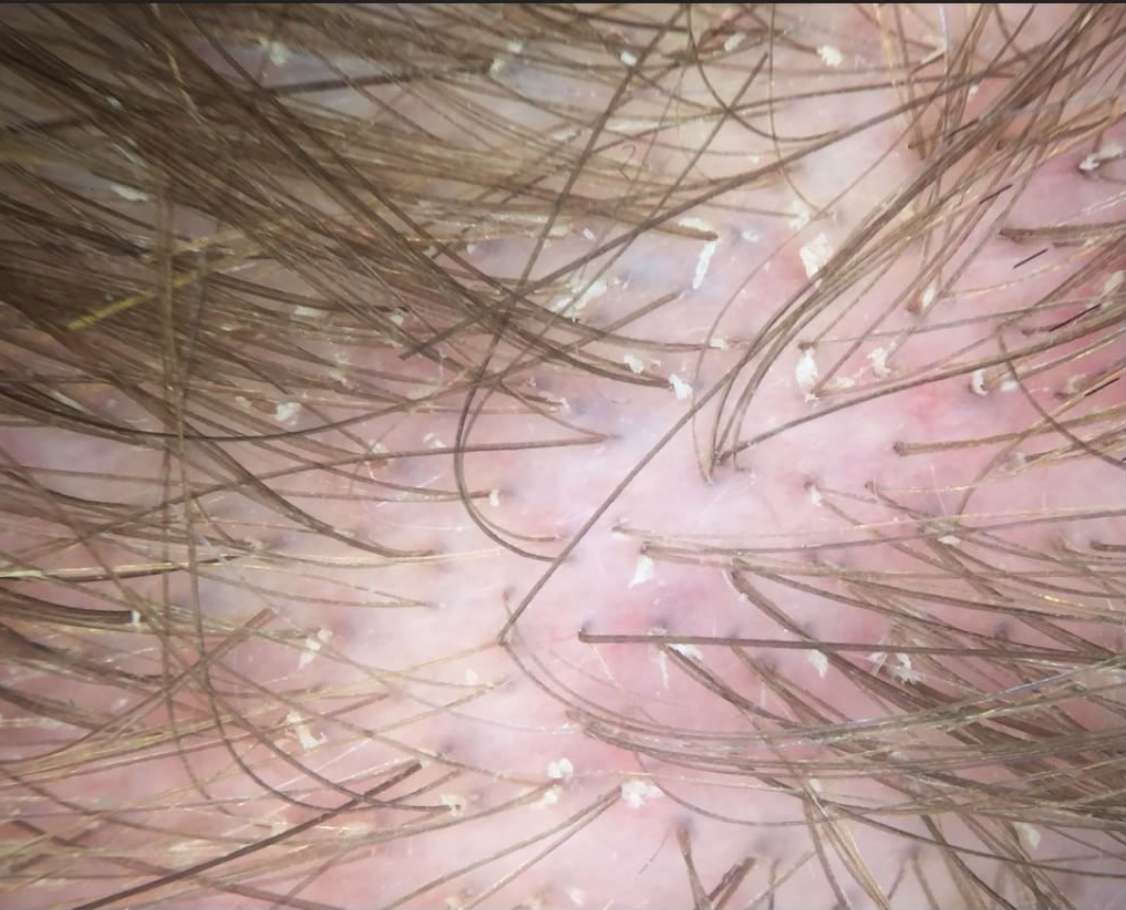 Seborrheic dermatitis How common is it? — Donovan Hair Clinic