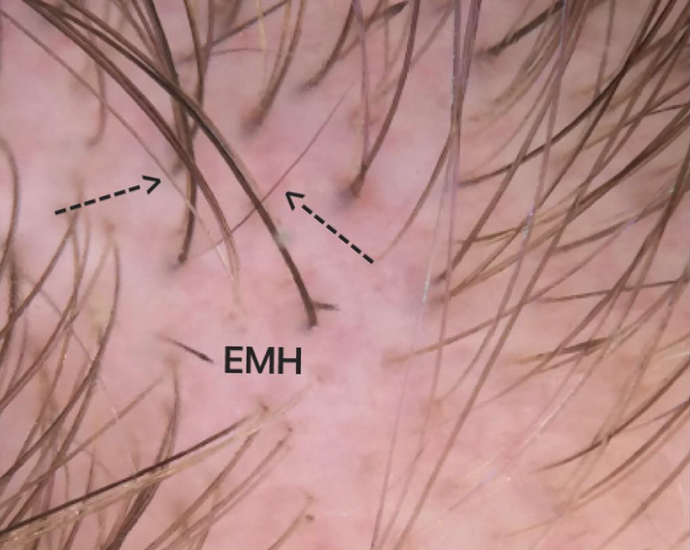 Alopecia areata up Close: A look at Exclamation mark hairs — Donovan Hair  Clinic