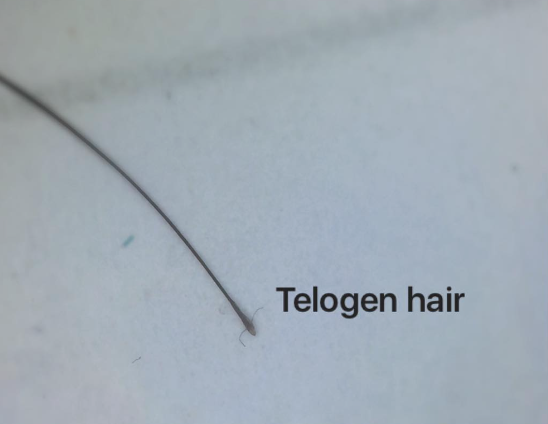 Telogen hairs: Not only in Telogen Effluvium — Donovan Hair Clinic