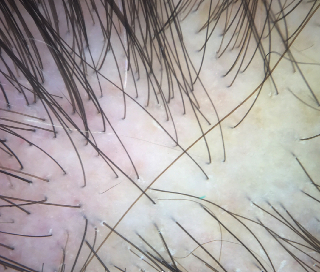 Scarring Alopecia LPP Donovan Hair Clinic