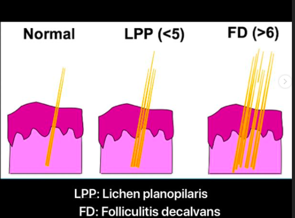lpp-vs-fd.png