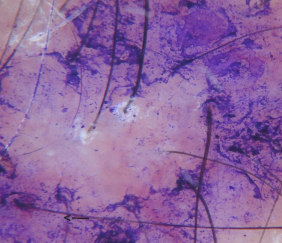SINGLE HAIRS IN LICHEN PLANOPILARIS