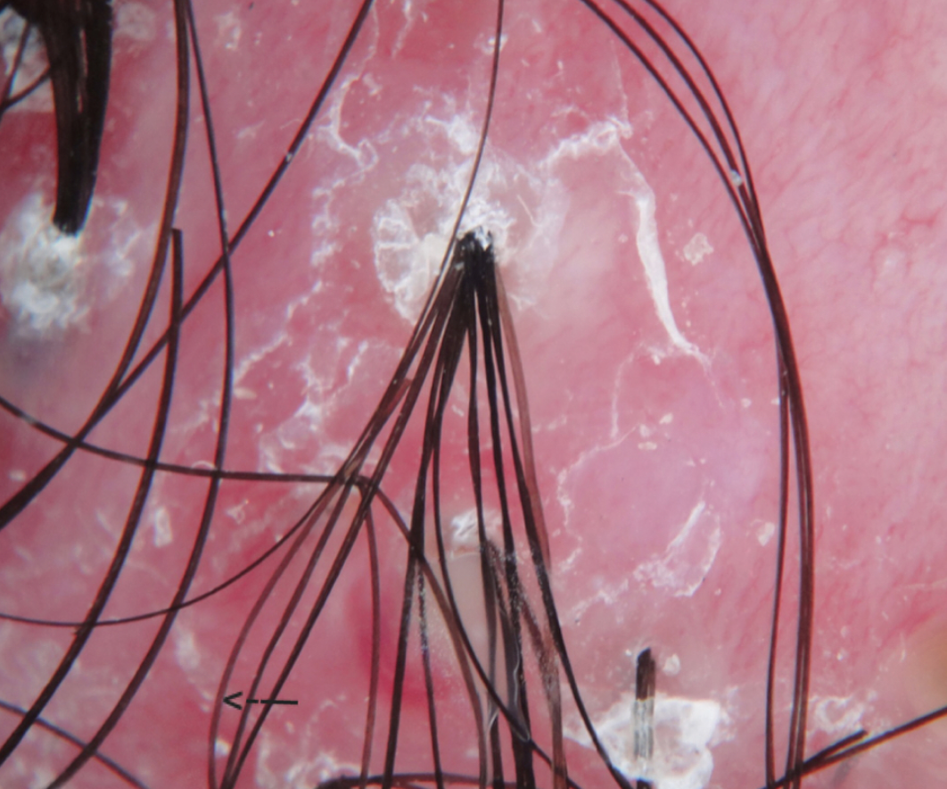 COMPOUND HAIRS IN FOLLICULITIS DECALVANS