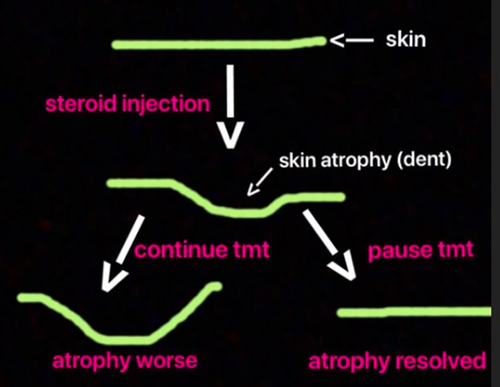 Steroid Injections Atrophy Dents Depressions Holes Donovan