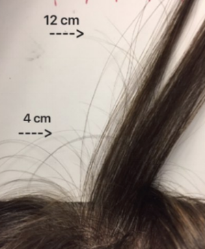 Recognizing Hair Regrowth — Donovan Hair Clinic