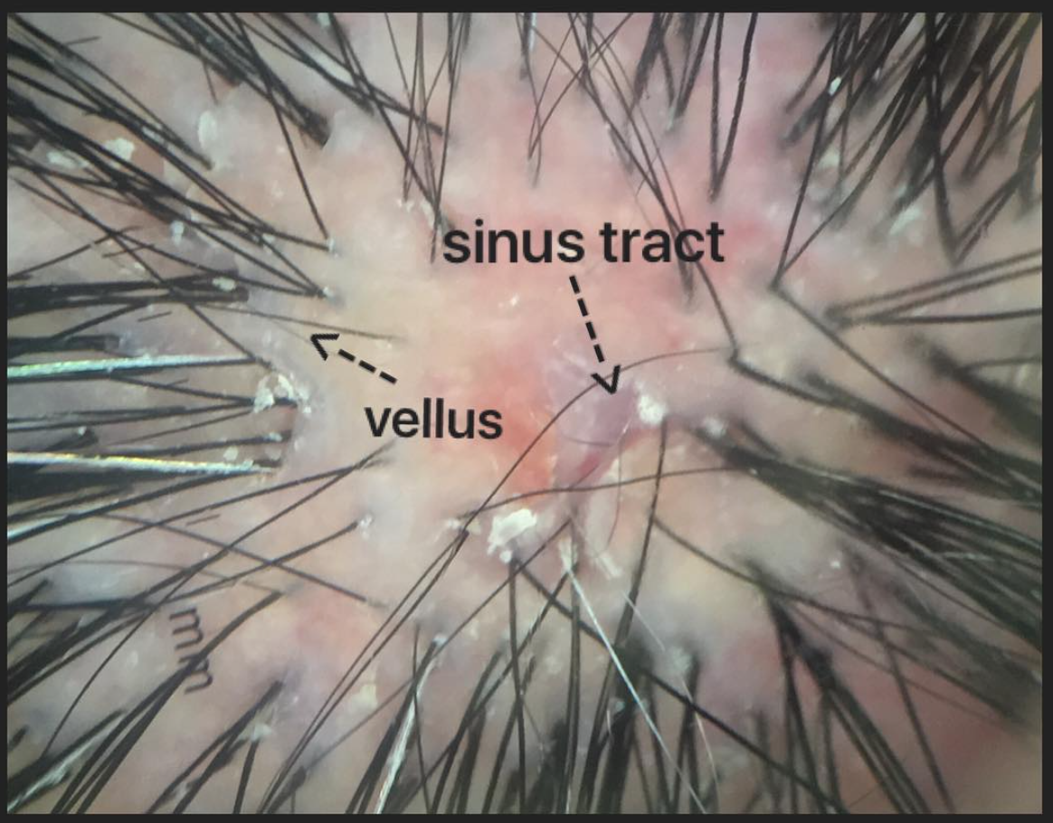 Dissecting Cellulitis