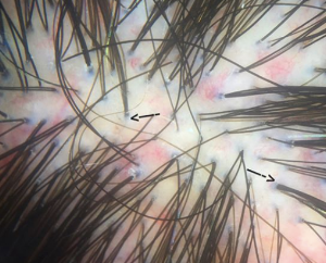 compound follicles.png